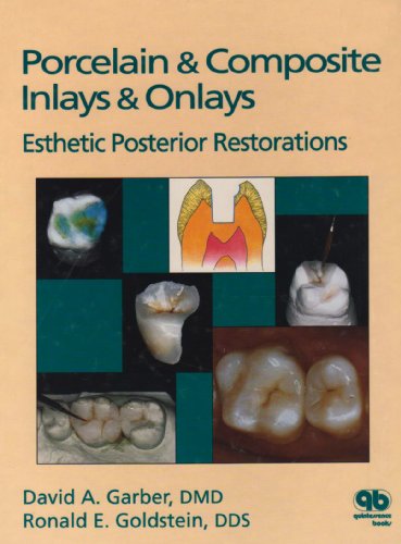 Porcelain & Composite Inlays & Onlays: Esthetic Posterior Restorations