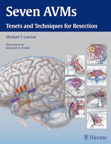 Seven AVMs: Tenets and Techniques for Resection